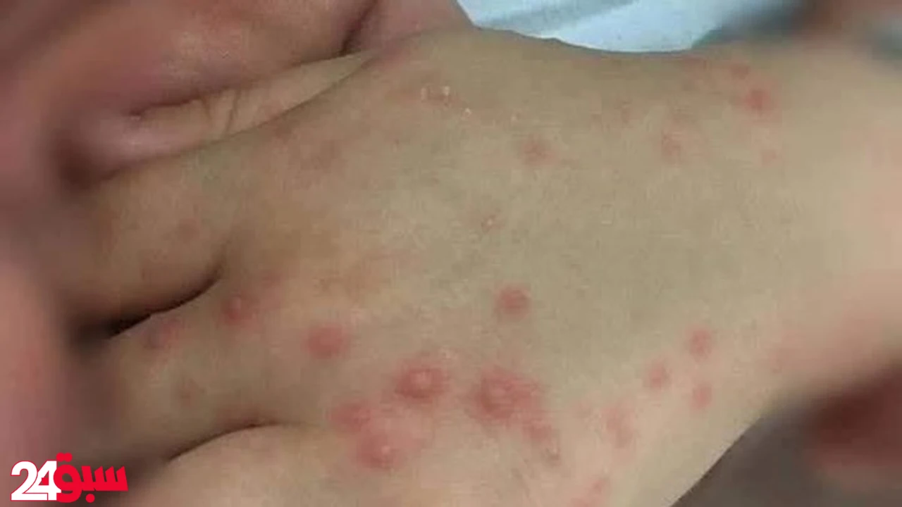 فيروس اليد والقدم والفم: طبيبة تحذر من الأسبرين وتكشف طرق الوقاية